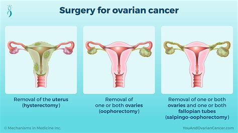 Slide Show - Treating and Managing Ovarian Cancer