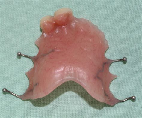 Partial Dentures (plates) - Northland Prosthodontics - Northland ...