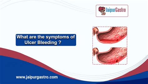 What are the symptoms of Ulcer Bleeding in 2022 | Dr. Shankar Dhaka