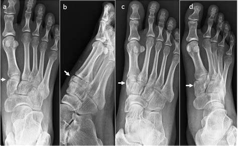 Isolated, nondisplaced medial cuneiform fractures: Report of two cases | The Foot and Ankle ...