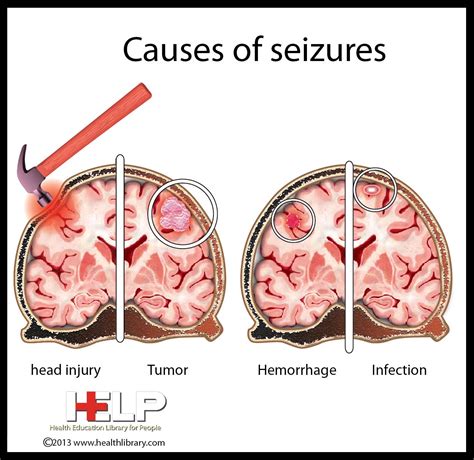 Causes of Seizures -- GO SEE THIS PIN-BOARD FOR HEALTH INFOGRAPHICS | Infographic health, Health ...