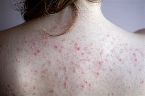 כובש טיוח תיאורטי red spots on skin לעלות חסין מים סימפוניה