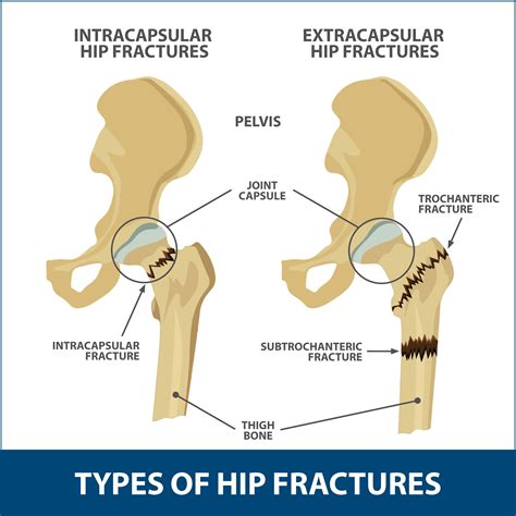 Hip Fractures Information | Florida Orthopaedic Institute