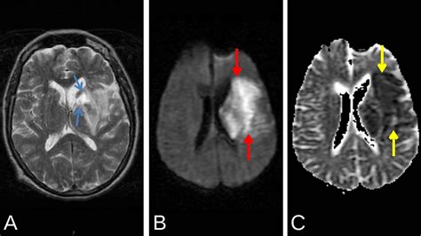 Left MCA Infarct with Hyperdense MCA Sign