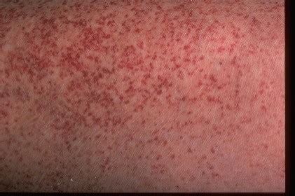 What Causes Little Red Dot on the Skin? | New Health Advisor