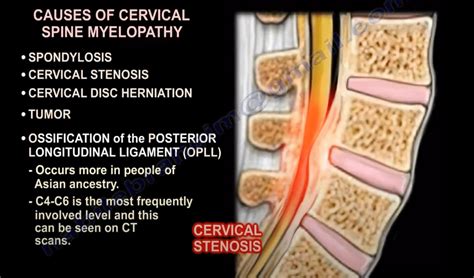 Myelopathy: Definition - Spine Info