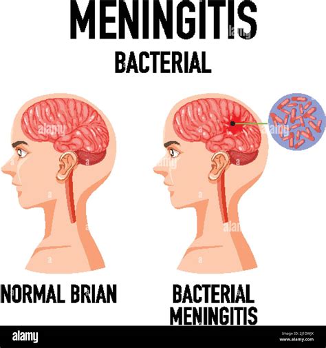 Diagram showing meningitis bacterial in brain illustration Stock Vector ...