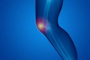 Patellofemoral Arthritis: Symptoms and Complications