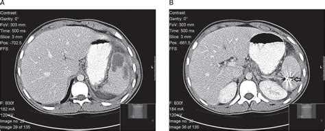 Splenic abscess | Oncohema Key