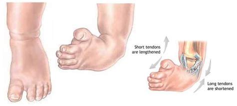 Corrective Clubfoot Surgery In India From Best Pediatric Surgeon | Pediatrics, Nursing care, Surgery