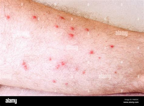 Allergic reaction to the leg Stock Photo: 88953800 - Alamy