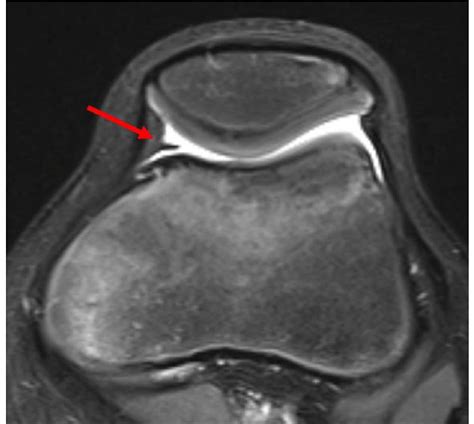 MRI (1.5 T PD fat sat FSE) coronary plane showing a medial plica ...