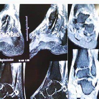 Intraoperative image showing peroneus brevis tendon sbluxated over the... | Download Scientific ...