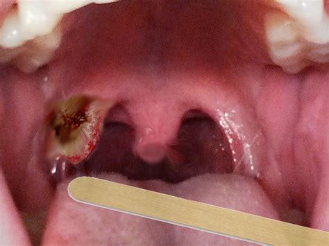 Lingual Tonsil Cancer Symptoms