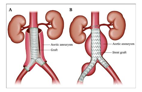 EVAR: Your Solution for Aortic Aneurysm Care