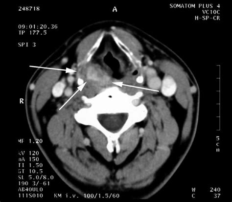 What Is A Ct Scan With Contrast Of The Neck | Images and Photos finder