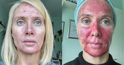 This Woman's Graphic Selfies Bring the Skin Cancer Risks of Tanning to Life | Glamour