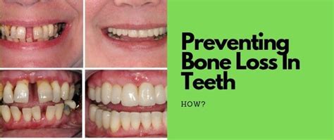 How To Prevent Further Bone Loss In Teeth - Follow These Tips Now ...