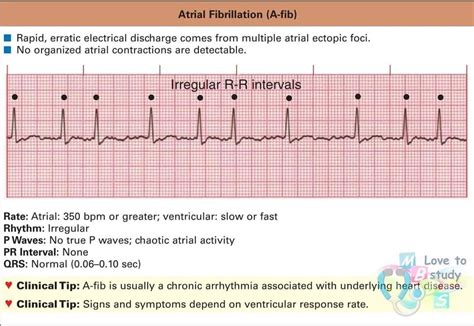 Er Rn, Pr Interval, P Wave, Cardiac Nursing, Atrial Fibrillation ...