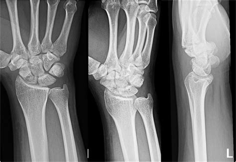 Carpal Bone Fracture