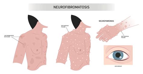 Neurofibromatosis type 1: What’s in a Name?