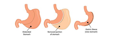 Sleeve Gastrectomy Surgery - Op.Dr. Tufan Ergenc