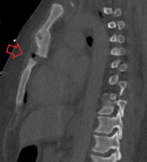 A Novel Approach to Sternal Fracture Repair With the Implementation of a Compression/Distraction ...