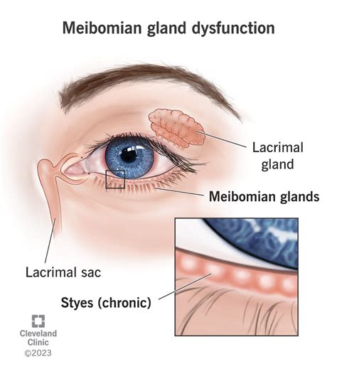 Meibomian Gland Dysfunction: Symptoms & Treatment