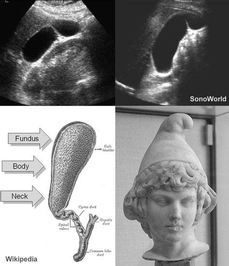 Phrygian Cap Gall Bladder (With images) | Diagnostic medical sonography ...