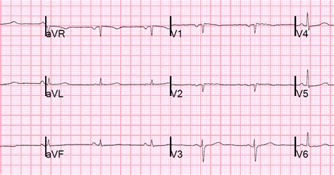 Dr. Smith's ECG Blog: Chest Pain and Q-waves in V1 and V2. Is there previous septal MI?