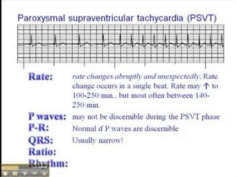 ECG: Paroxysmal Supraventricular Tachycardia (PSVT) | RN Education | Pinterest | Nclex, Cardiac ...