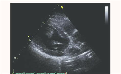 Severe global hypokinesia with akinesis of the anterior, antero-lateral... | Download Scientific ...