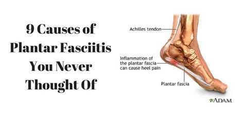 Causes Of Plantar Fasciitis