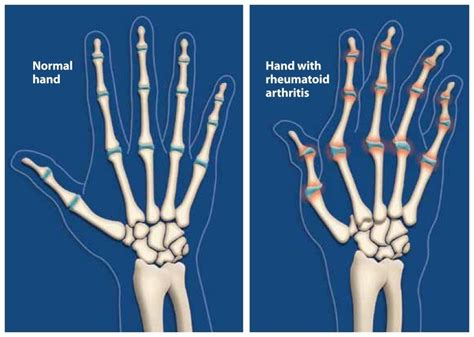 Rheumatoid arthritis,WHAT YOU NEED TO KNOW?