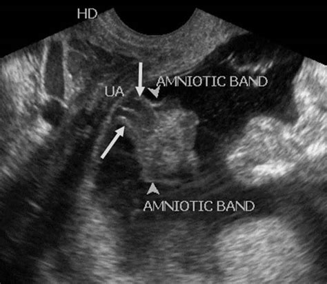 Amniotic band syndrome causes, symptoms, diagnosis & treatment