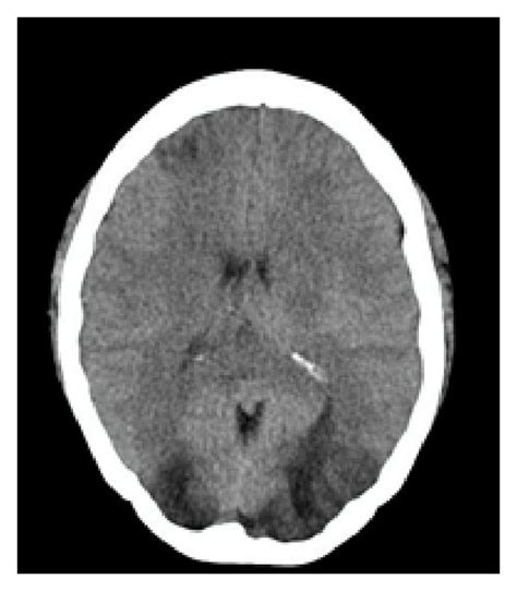 (a) Brain CT scan showing hypodense lesions in subcortical white matter ...