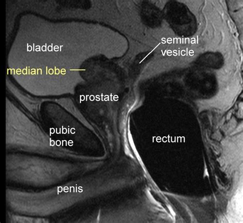 Prostate Gland Anatomy Mri