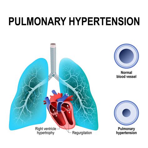 Pulmonary Arterial Hypertension - Rare Disease Advisor