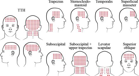 Where is My Tension Headache Coming From? - REP Physio