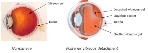 Posterior vitreous detachment (PVD) – The Royal Victorian Eye and Ear ...