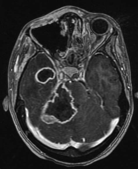 Lethargy and vision loss: successful management of rhinocerebral ...