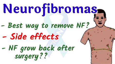 how we can remove neurofibromatosis ?? || neurofibromatosis cure #nofearwithneurofibromatosis ...