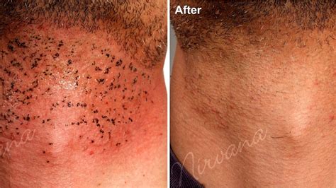 Side Effects Of Laser Hair Removal - Effect Choices