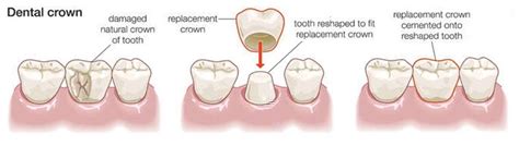 Having A Crown Fitted At The Dentist - FitnessRetro