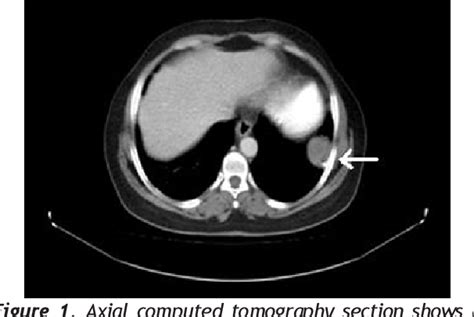 Figure 2 from Solitary Fibrous Tumor of the Pleura | Semantic Scholar