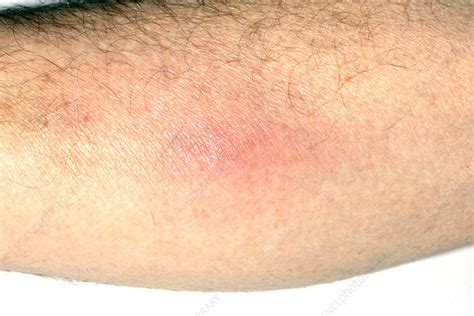 Superficial thrombophlebitis - Stock Image - C026/3410 - Science Photo Library