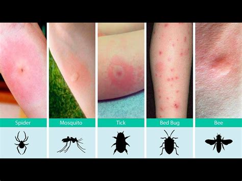 Pin by Merry Hamrick on Health/Medical | Bed bug bites, Bug bites, Bed bugs