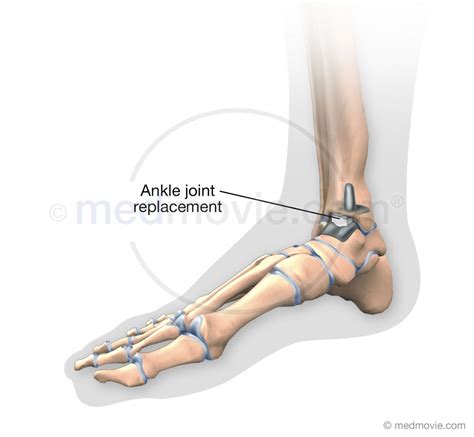 Ankle Joint Replacement – Medmovie.com