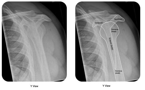 Shoulder Dislocation – OrthoSHO