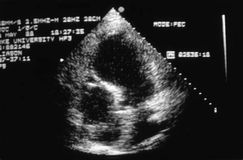 Apical mural thrombus: technical pitfalls | Heart